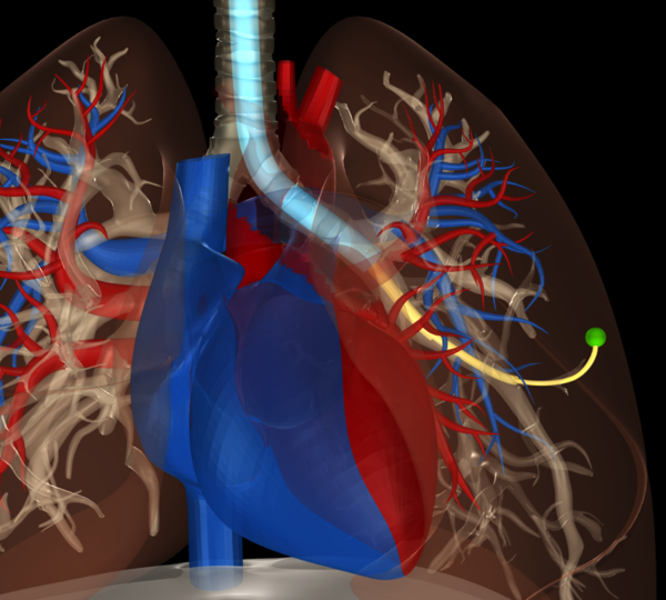 Bronchoscope-deplyed steerable needle system for trans-oral lung biopsy