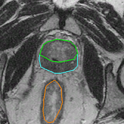 Given probe-out image